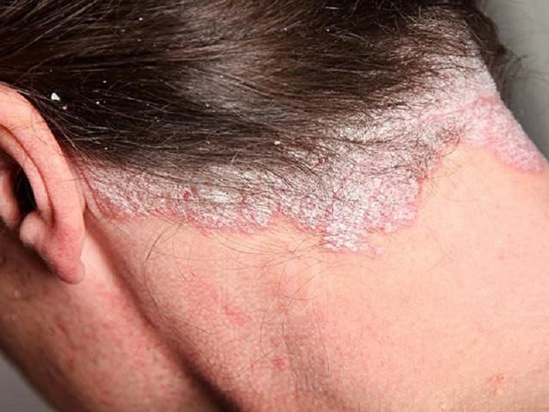 Những vấn đề da thường gặp ở nam giới và cách khắc phục