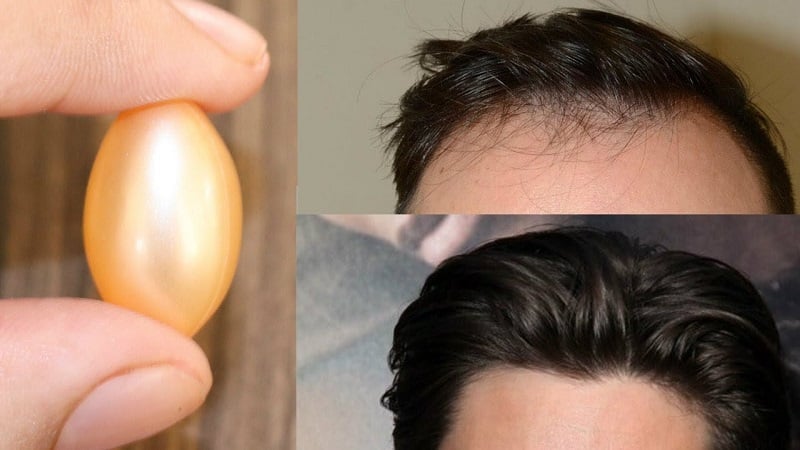 Những vitamin cần thiết giúp nam giới có mái tóc đẹp