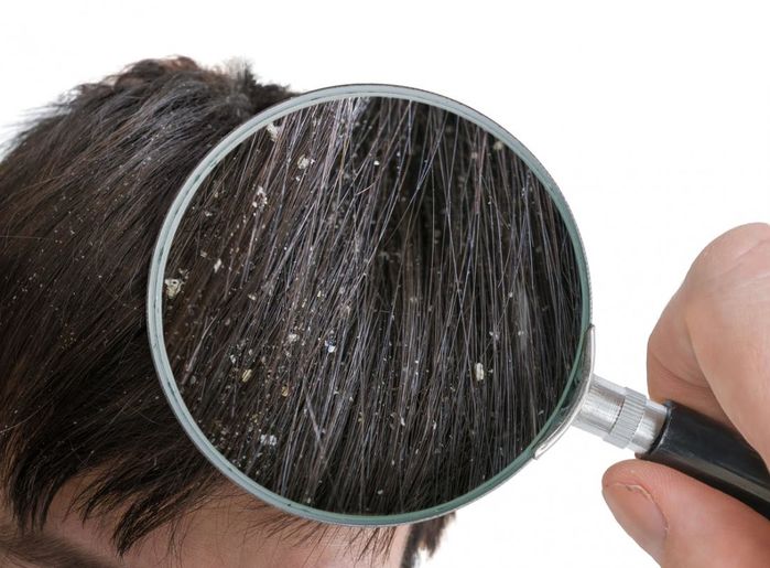 Sử dụng sản phẩm chăm sóc tóc kém chất lượng sẽ gây ra nhiều hiện tượng giống như gàu.