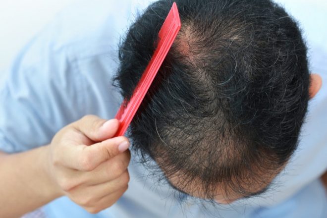 4 Sai lầm thường gặp khi điều trị hói đầu ở nam giới